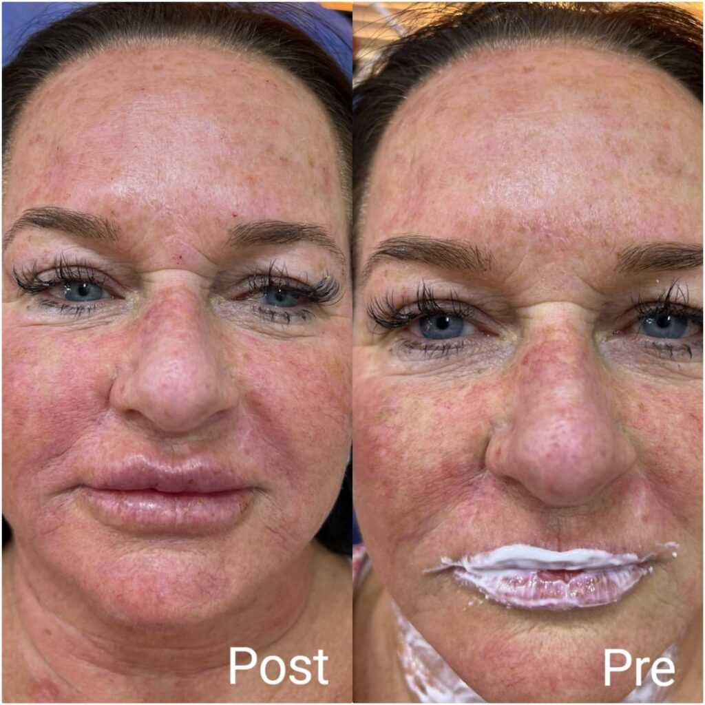 Lip augmentation with fillers